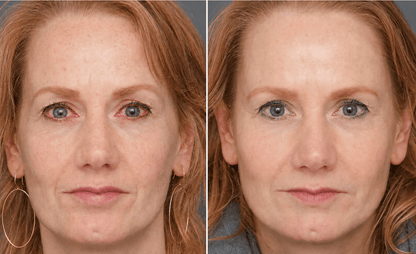 Lunaramint™ Vision Comfort Eye Patches
