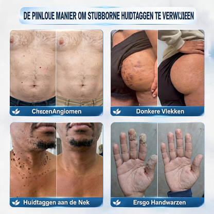 🔥Officiële merkshop | 🖊️Oryvessa™ 7-daagse wratten- en vlekkenverwijderaar (pijnstillende applicator voor nauwkeurig aanbrengen, laat geen littekens achter)